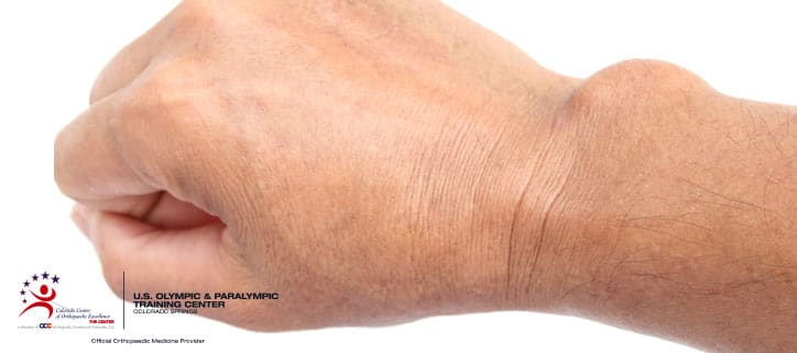 Ganglion wrist cyst remedies on home for 22 Effective