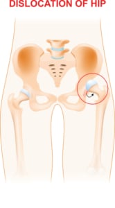 hip dislocation