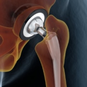 hip joint replacement