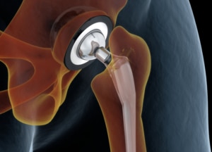 hip joint replacement