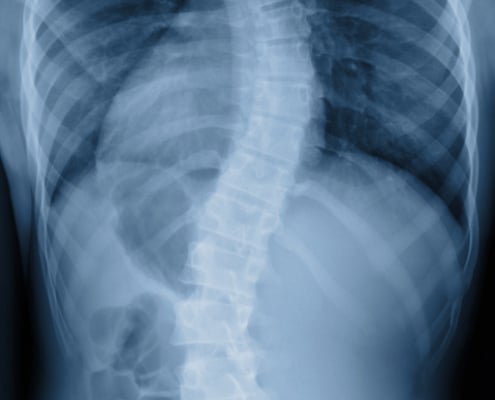 Scoliosis film x-ray show spinal bend in teenager patient