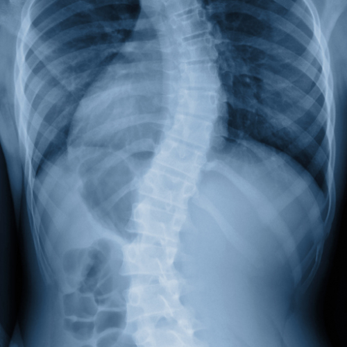 Scoliosis in SchoolAge Children Colorado Center of Orthopaedic Excellence