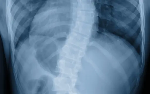 Scoliosis film x-ray show spinal bend in teenager patient