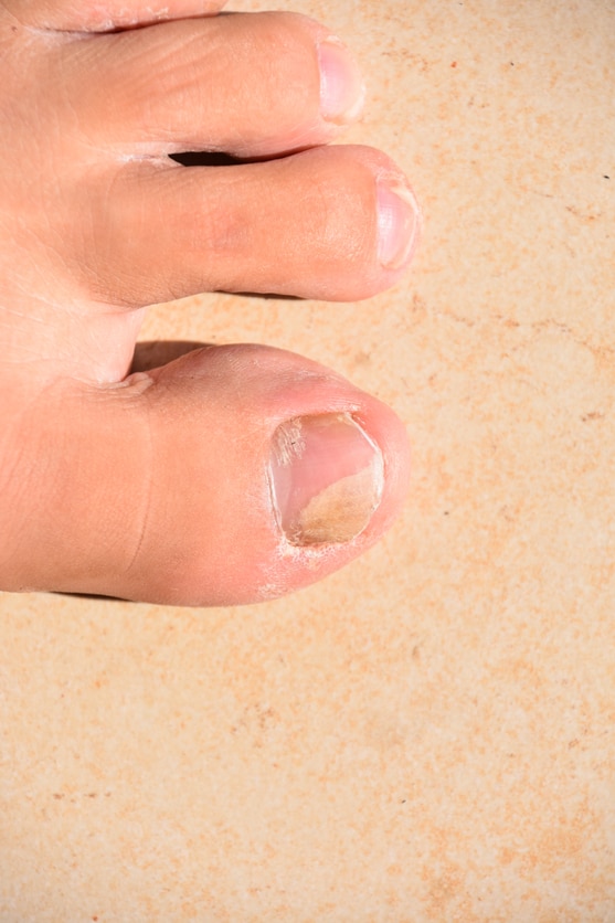 mold under toenail        <h3 class=