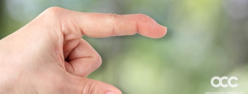 mallet finger