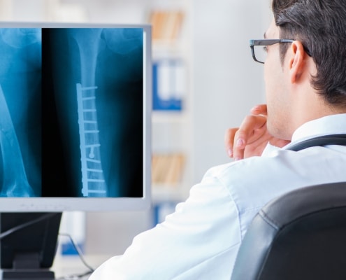 Femur Fracture