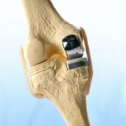 Unicompartmental Knee Replacement