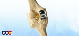 Unicompartmental Knee Replacement